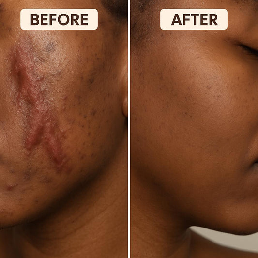 Crème Anti-Cicatrices Yoxier® à la Lavande – Répare, Apaise & Unifie la Peau